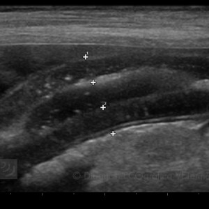 LIMFANGIECTASIA INTESTINAL